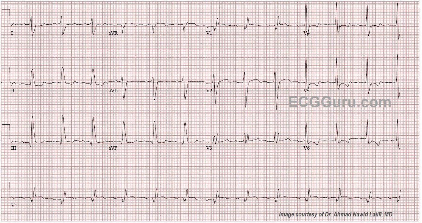 Bifascicular Block Ecg Review Learn The Heart vrogue.co